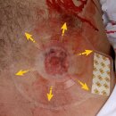 H&H Medical H-Vent Twinpack Chest Seal